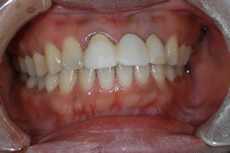 前歯のインプラント治療例_術前