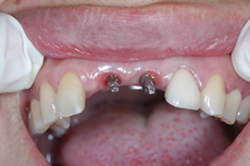 前歯のインプラント治療例_術後