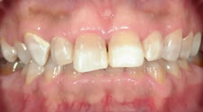 先天的な変色歯のホワイトニング術前