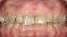 先天的な変色歯のホワイトニング術後