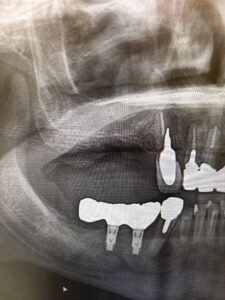 右上インプラント埋入前