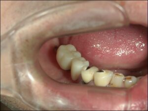 右下の奥歯インプラント