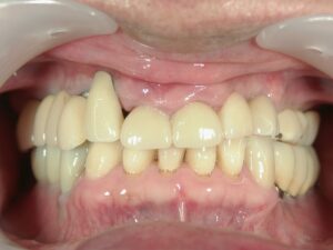 前歯部インプラント治療後